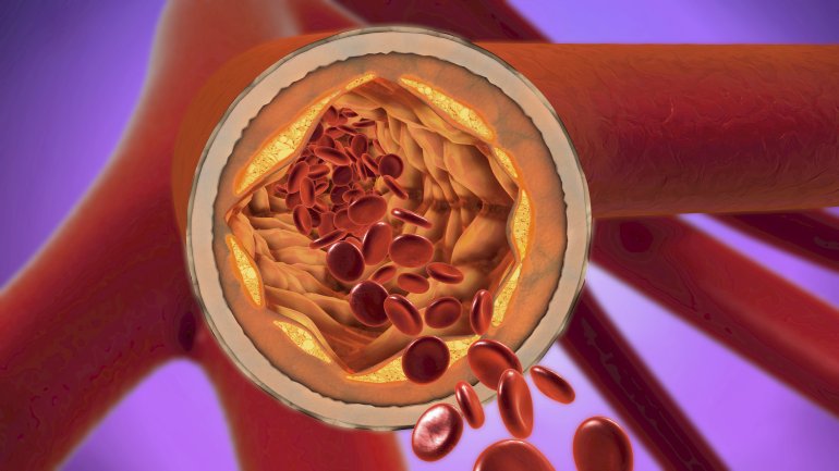 Arteriosklerose führt zu einer Verengung der Blutgefäße.