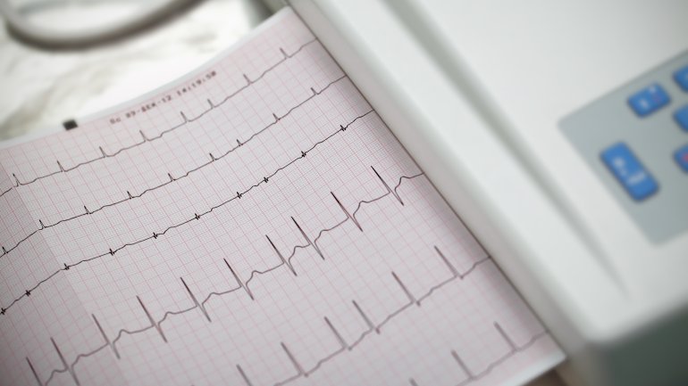 EKG-Diagramm bei Vorhofflimmern wird ausgedruckt