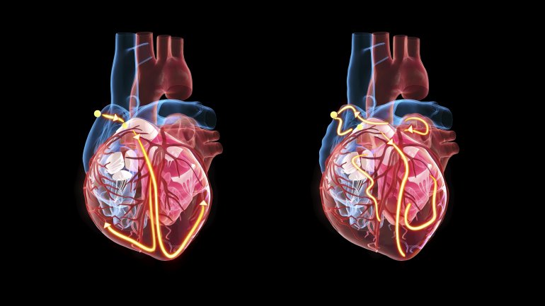 Das elektrische Signal, das den Herzschlag auslöst, entsteht im rechten Vorhof.