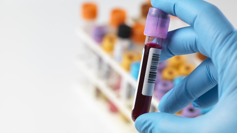 Blutprobe wird im Laboruntersucht, um den Homocysteinwert zu bestimmen
